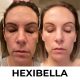 Dispositivo Hexibella MicroGlow