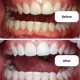 NanoSmile Set