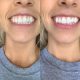 NanoSmile Set